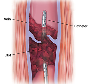 Understanding Percutaneous Transcatheter Treatment of Deep Vein Thrombosis ( DVT)