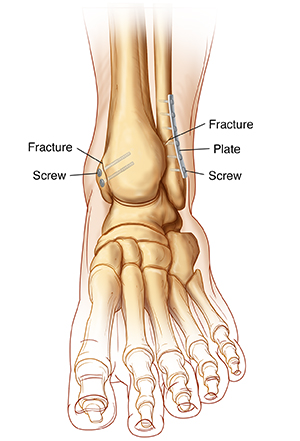Having Ankle Fracture Open Reduction and Internal Fixation