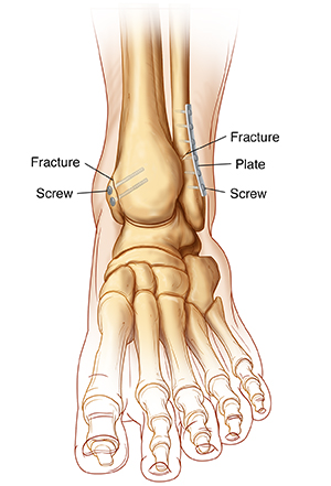 What are Ankle Fibula Fractures & How Are They Treated? - Upswing Health