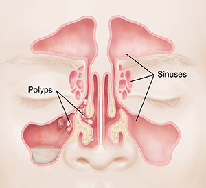 Enlarged nasal shop polyps