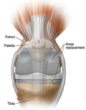 MIS Knee