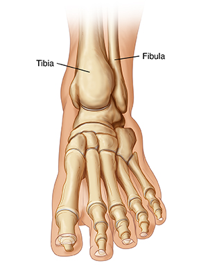 Pilon Fracture of the Ankle | Saint Luke's Health System