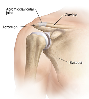 What to expect when you're not expecting, an acromioclavicular (AC