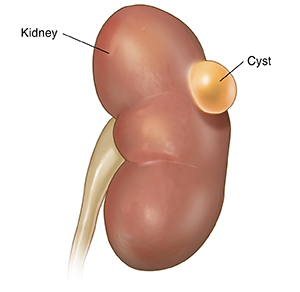 Kidney Cysts: Causes, Symptoms, Treatment & Prevention