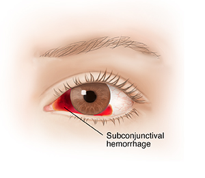 Front view of eye with subconjunctival hemorrhage.