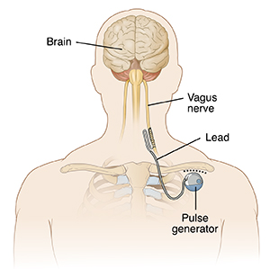 The vagus nerve-stimulation device used for implantation, obtained