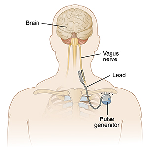 Placement of vagus nerve stimulation device. As illustrated in the