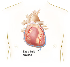 Front view of person's chest showing extra fluid drained from the pericardium.