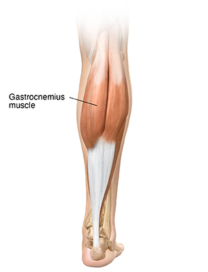 illustration of biology and medical, calf tear and Torn Calf Muscle, A torn  calf muscle is an injury that causes a partial or complete tear in the  muscles behind shin bone Stock