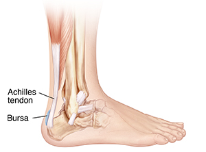 Bursitis deals heel treatment