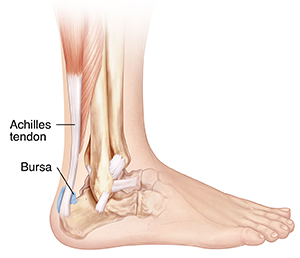 Heel bursa store treatment