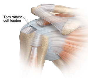 What Are Torn Rotator Cuff Symptoms? Doctors Explain How To Treat