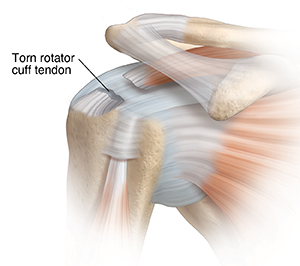 Symptoms of Torn Rotator Cuff Tendon