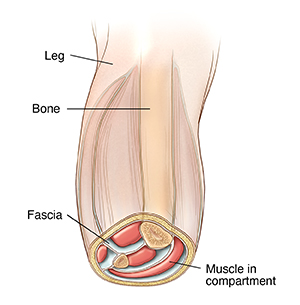 Understanding compartment syndrome by type