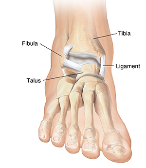 Broken Ankle (Ankle Fracture)
