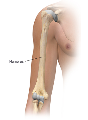 Sarmiento Brace, Humeral Fracture Splint and Upper Arm Support for Broken  Humerus with Sling