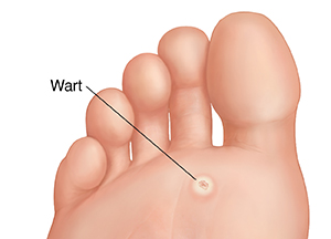 Wart store on toe