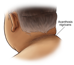 Acanthosis deals