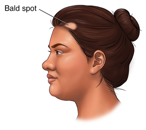 Alopecia Areata In Women