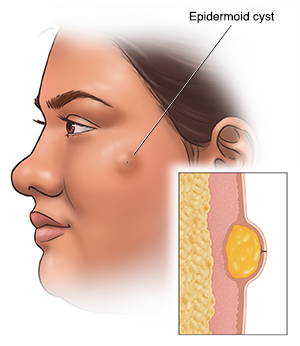 Understanding Epidermoid Cyst