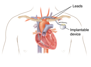 Replacing a pacemaker with a device the width of a human hair