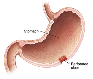 Cross section of stomach showing perforated ulcer.