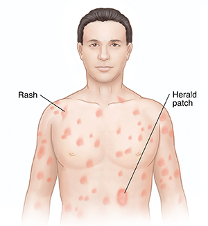 Pityriasis Rosea Treatment NYC - What is Pityriasis Rosea?