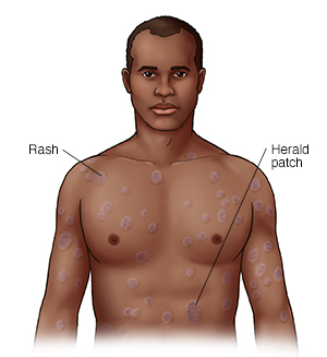 Front view of man's head and chest showing pityriasis rosea.