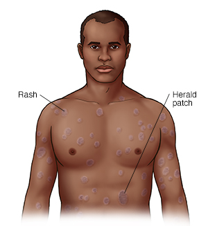 Understanding Pityriasis Rosea