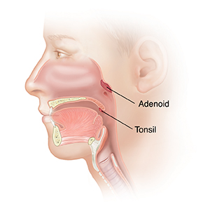 What Should you Expect during Post-Operative Care after Adenoidectomy?