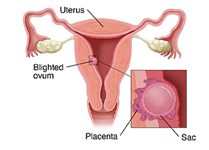 Any advice on whether I have passed the pregnancy tissue/ sac