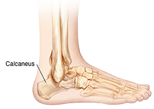 Cracked heel sale bone