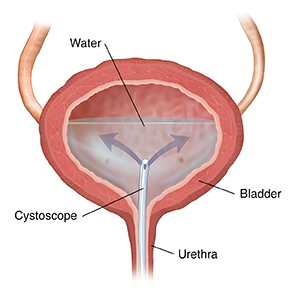 Urethritis in Women  Saint Luke's Health System