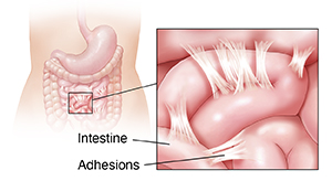 Laparoscopic pictures of the fibrinous adhesion, dark brownish ascetic