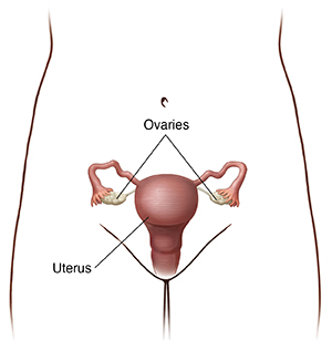 Ovarian cysts Information