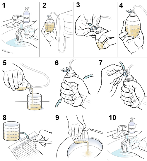 Step-by-Step: How to Empty Your Drain After Surgery | Saint Luke's ...