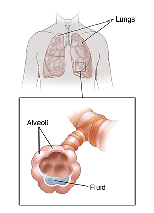 Respiratory Distress in a Patient with Clear Lungs: What You Need