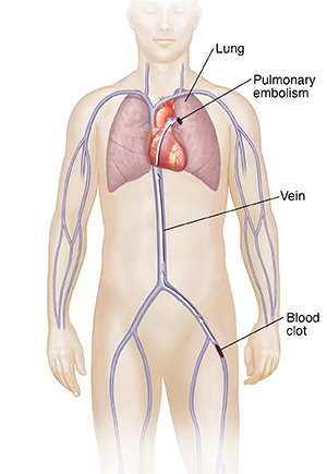 Anatomy Chart Deep Vein Thrombosis