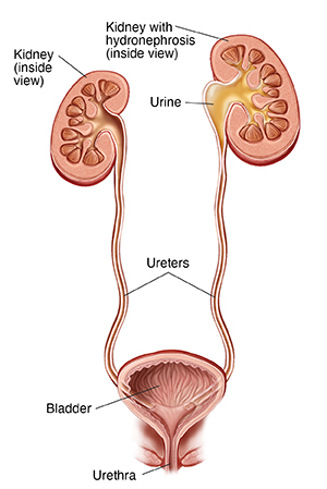 Hydronephrosis in Children  Symptoms, Causes, Treatment and other