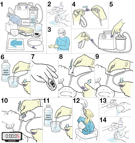 Pediatric Tracheostomy: Overview, Periprocedural Care, Technique