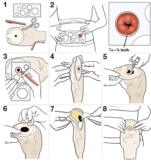 Step-by-Step: Stoma Care: Sizing the Opening