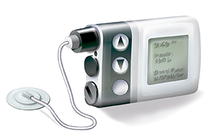 – Emergency Medicine EducationInsulin Pumps