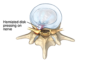 Tailbone (Coccyx) Fracture  Saint Luke's Health System