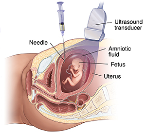 Pregnancy needle outlet test