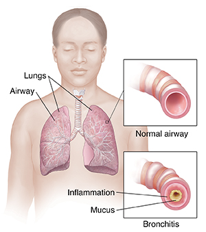 What Is Acute Bronchitis? | Saint Luke's Health System