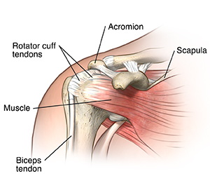 Shoulder rotator cuff clearance tendonitis