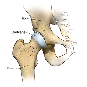 Total hip replacement