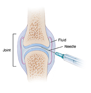 Joint Aspiration  Saint Luke's Health System