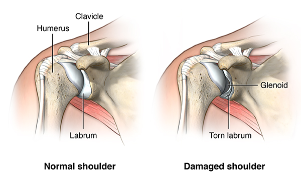 Shoulder Dislocation Saint Luke S Health System
