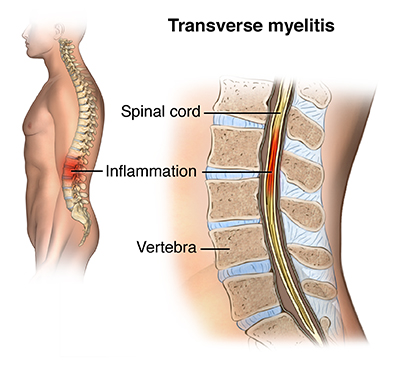 Transverse Myelitis | Saint Luke's Health System